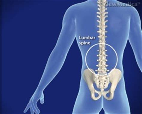 Lumbar Laminectomy - Seattle, WA - Brain and Spine Surgery