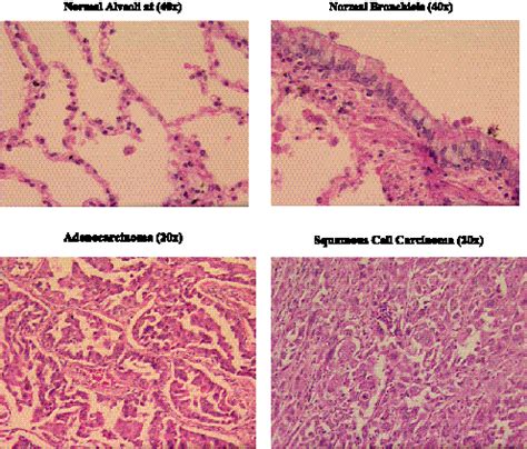 Histology of normal and tumor tissues used in this study. | Download ...