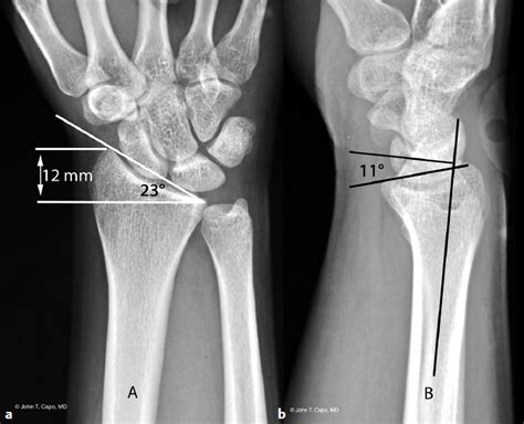 Distal Radius Fractures | Musculoskeletal Key