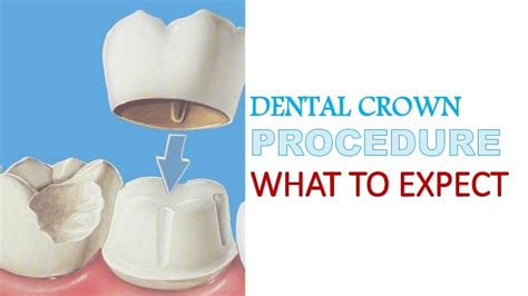 Dental Crown Procedure - What to Expect