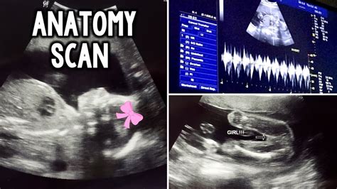 ANATOMY SCAN | 21 WEEKS ULTRASOUND - YouTube