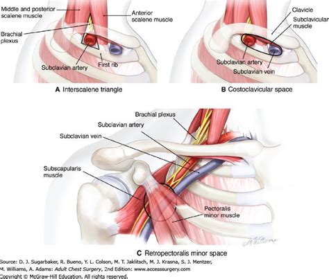 Thoracic Outlet Syndrome - Shoulder & Elbow - Orthobullets