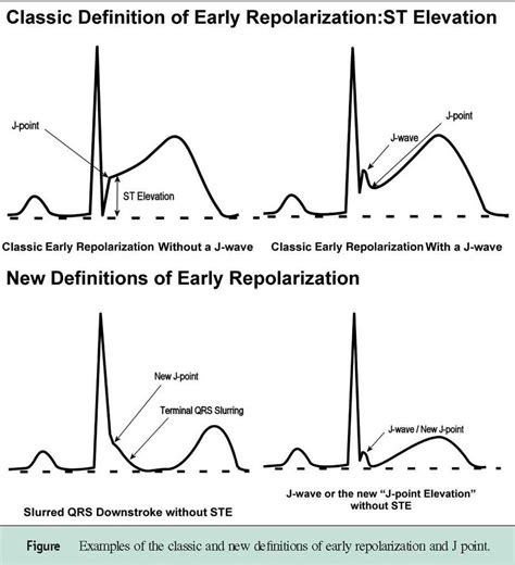 Cardiovascular Adaptations to Exercise and the Athlete EKG • truPhys