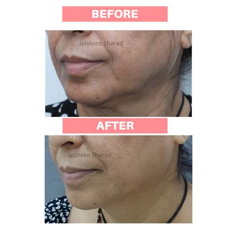 Liquid Face Lift – DR. JAISHREE SHARAD