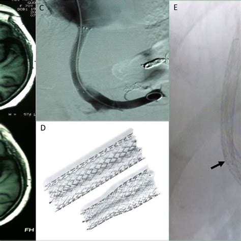 TIPS shunt limiting and cranial MRI changes. (A) Before stent limiting... | Download Scientific ...