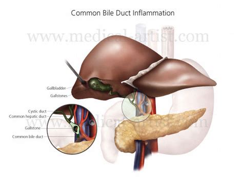 Bile Duct Diseases