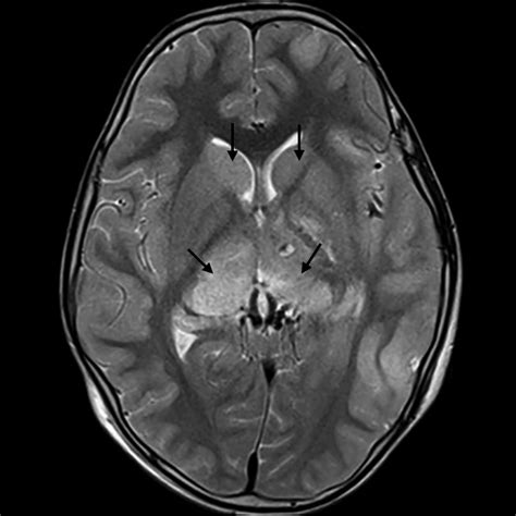 Brain Lesions Mri