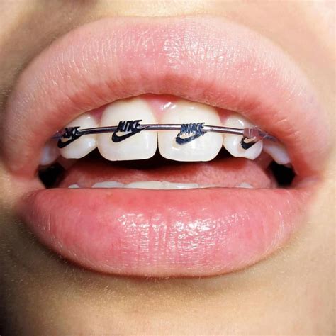 Pin by Caroline Monaghan on Rae x Caroline | Cute braces, Cute braces ...