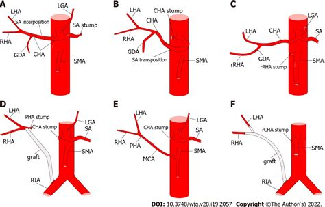 Clinical significance of variant hepatic artery in pancreatic resection: A comprehensive review