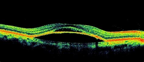 Chronic Atypical CSCR - Retina Image Bank