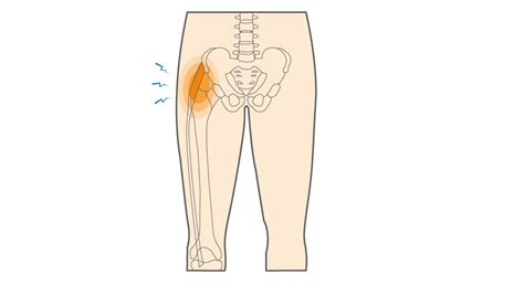 What is Iliotibial (IT) Band Tendonitis of the Hip & How to Manage ...