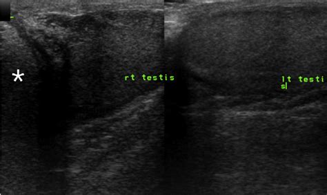 Figure 1 from The Case of Huge Pure Lipoma of the Spermatic Cord ...