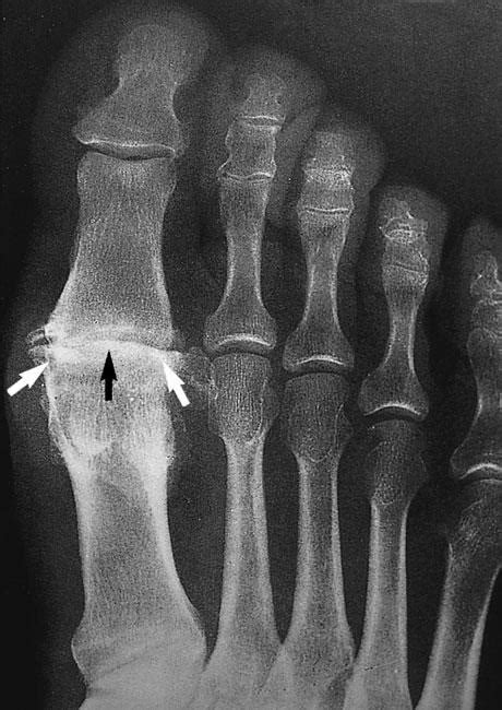 Arthritis of the Foot and Ankle - OrthoInfo - AAOS