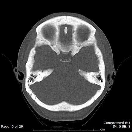 Hyperostosis of the skull (differential) | Radiology Reference Article | Radiopaedia.org