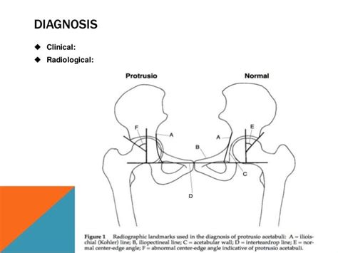 Protrusio acetabuli