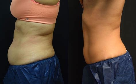 Body Contouring With Coolsculpting Before and After | Dr. Jeffrey Wise Cellulite, Blue Water Spa ...