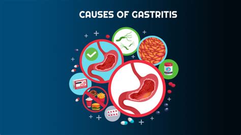 Gastritis-Causes, Treatment And Diagnosis – NutritionFact.in