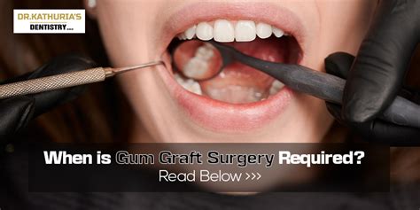 When is A Gum Graft Surgery Required? | Delhi Dental