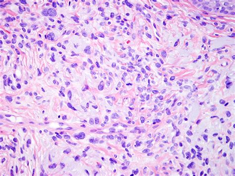 Atypical Fibroxanthoma | Dermatopathology