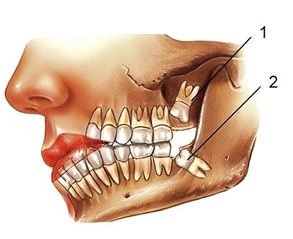 Wisdom Teeth Removal in Sydney - Sydney Dental Surgeons