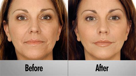 Vampire Facelift | Look Younger without Surgery or Downtime