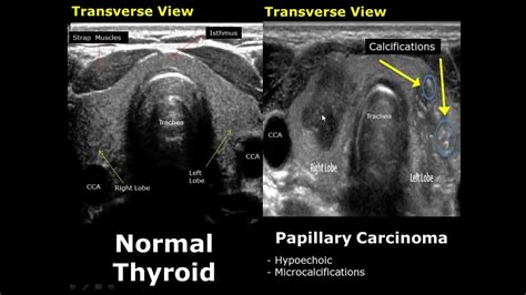 Normal Thyroid Ultrasound