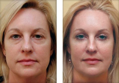 Remove Wrinkles With 5 Easy And Simple Steps - Fitneass