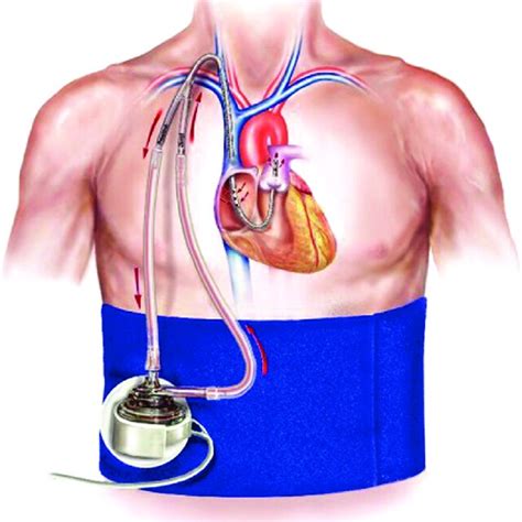 Impella RP Catheter. Courtesy of Abiomed. | Download Scientific Diagram