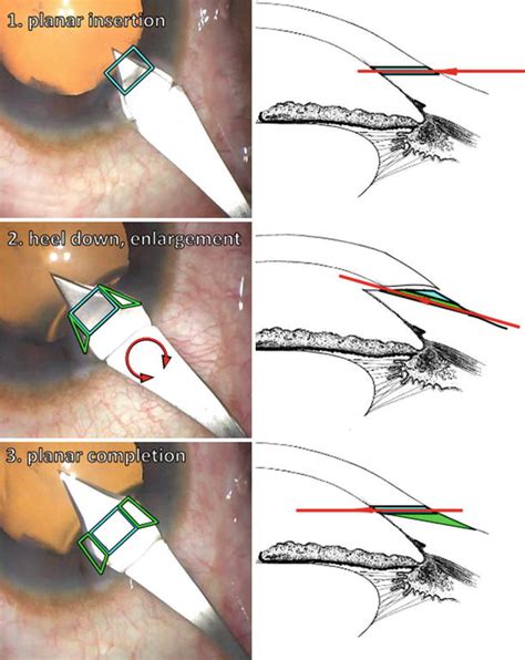 Minimally Invasive Glaucoma Surgery: Trabeculectomy Ab Interno | Ento Key