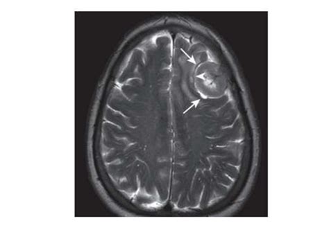 Parasagittal meningioma