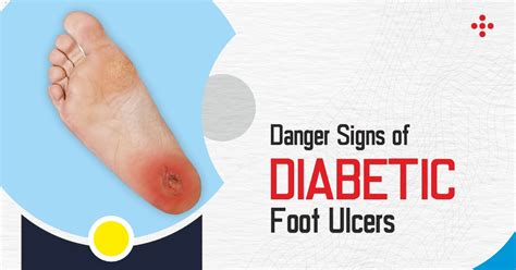 Diabetic Foot Ulcer Treatment | Danger Signs of Diabetic Foot Ulcers