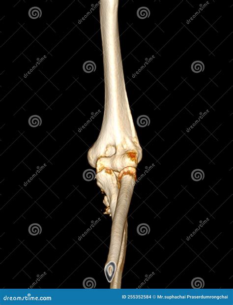 CT scan of elbow joint stock illustration. Illustration of examination - 255352584