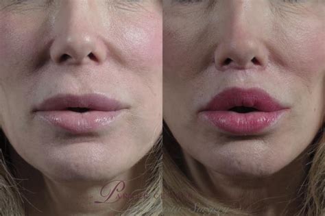 Lip Lift Before and After Photo Gallery | Paramus, New Jersey | Parker Center for Plastic Surgery