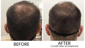 20+ Exosomes Hair Loss Before And After - KasonKeemaya