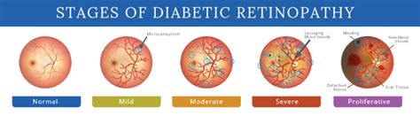 GitHub - BalajiAI/Diabetic-Retinopathy-Detection-using-Deep-learning: A Convolutional Neural ...