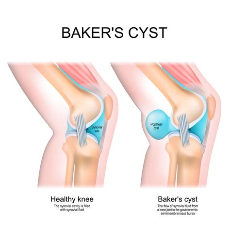 Baker's Cyst (Popliteal Cyst) Removal Surgery | VBJS