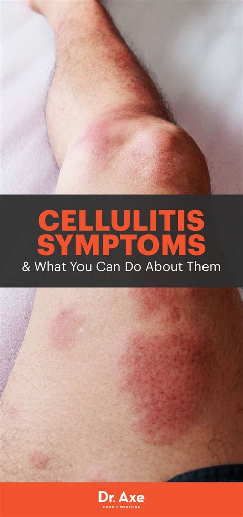 This Skin Condition Could Actually Be Lyme Disease | Plaque psoriasis treatment, Cellulitis ...