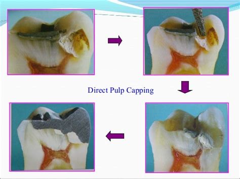 Pulp capping