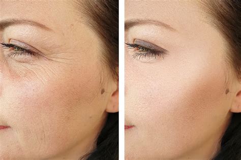 The Best Wrinkle Fillers on the Market and How Long They Last