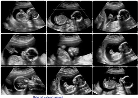 20 Week Anatomy Scan(Ultrasound Scan)? - Look After Babies