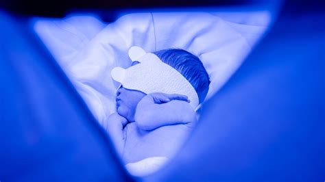 Bili Lights Phototherapy For Jaundice | Shelly Lighting