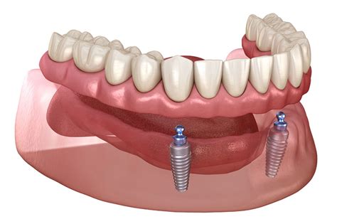 Implant-Supported Overdentures - D.R. Dental Clinics