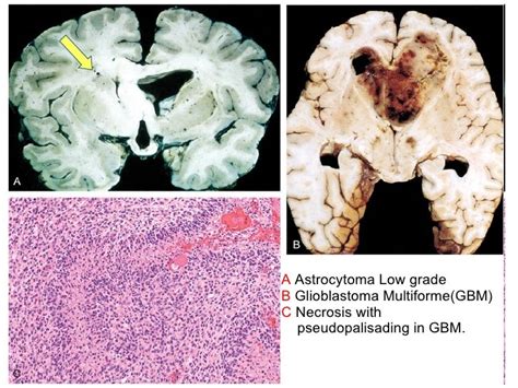 Pathology of CNS Tumors