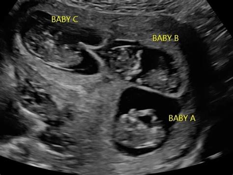 An early first trimester ultrasound with triplets. | Baby ultrasound, Triplets, Multiples baby