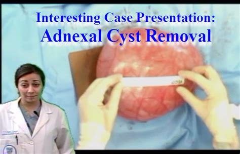 Surgical Subspecialties: Adnexal Cyst Removal - Anatomy Guy