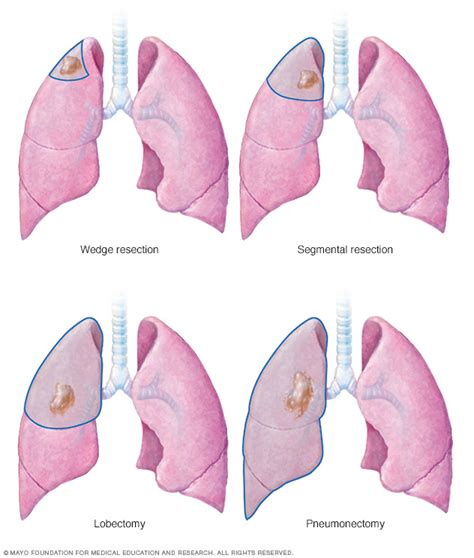 Lung cancer Disease Reference Guide - Drugs.com