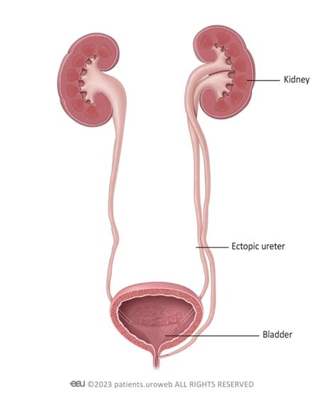 Ectopic Ureter - Patient Information