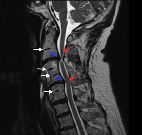 Cureus | Images in Spine: A Rare Abnormal Bony Fusion