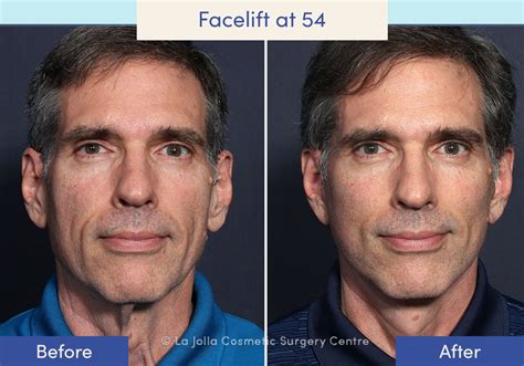 Facelift Before & After Photos: What a Facelift Looks Like at 40, 50 ...