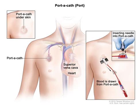 Cateter totalmente implantado ou Port-a-cath® | Enfermagem